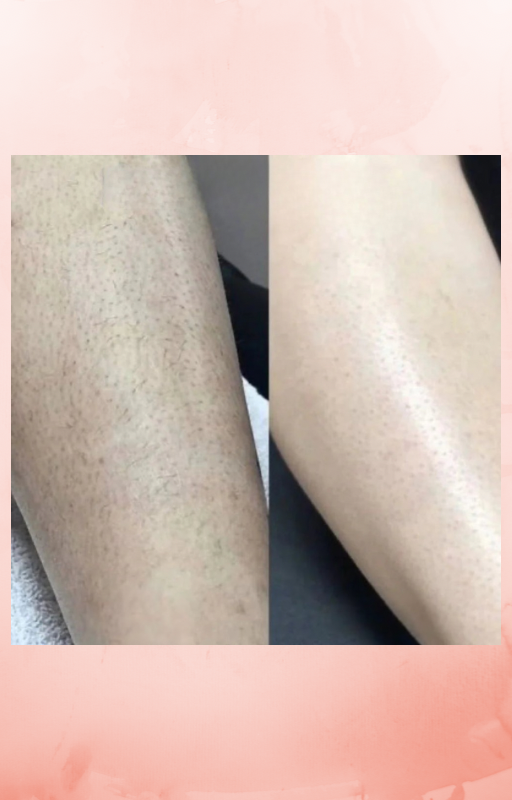 SilkTrim™ - Tondeuse 2-en-1 pour le Maillot et le Visage