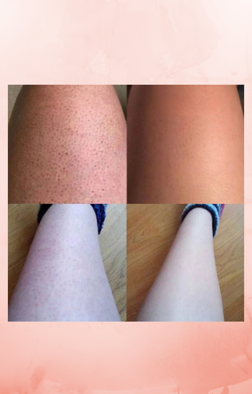 SilkTrim™ - Tondeuse 2-en-1 pour le Maillot et le Visage